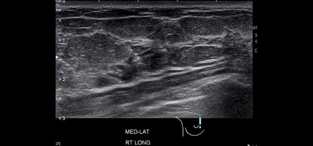 8_ultrasound breast_blog20141020