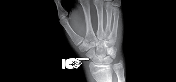 15 yo with scaphoid fracture after fall while skating_ap2_blog20141215