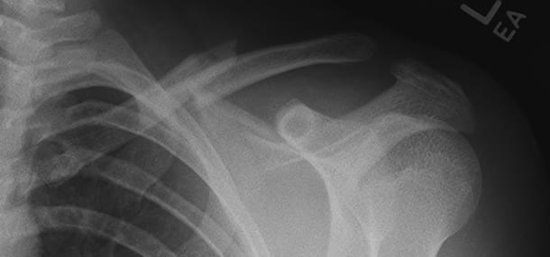 16 yo with left clavicle fracture after fall onto shoulder while skiing_1_blog20141215
