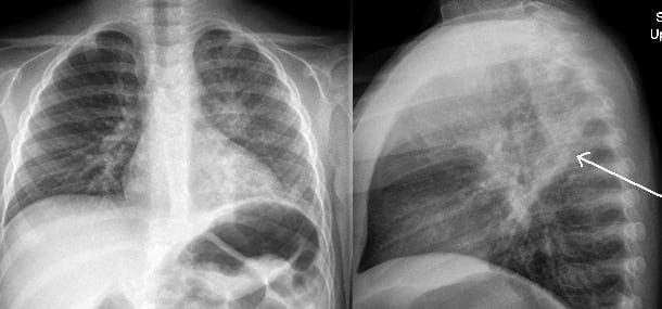 pnuemonia chest x-ray