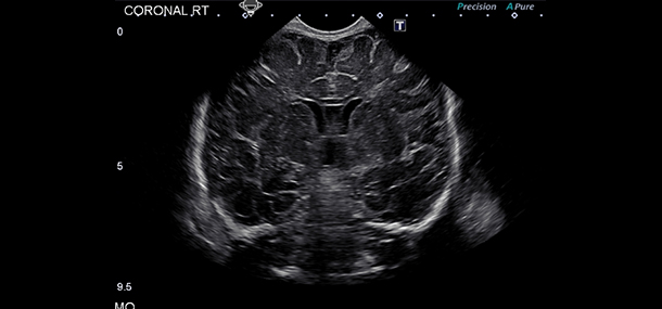 head ultrasound_blog20150511