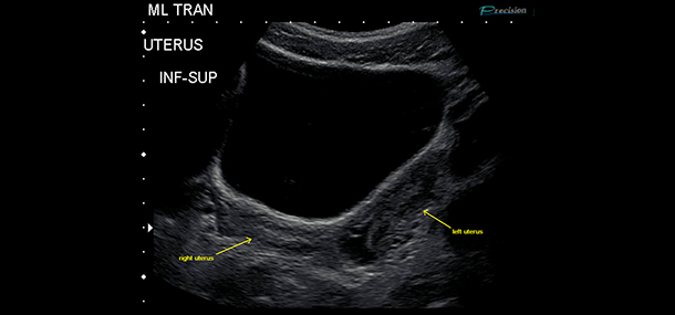 ultrasound two uterus_blog20150527