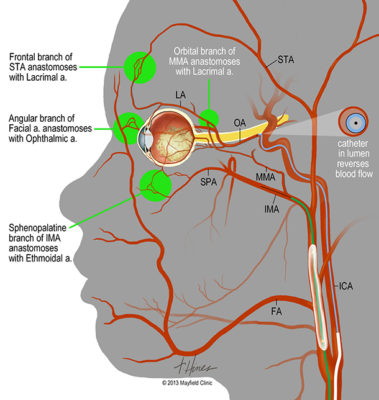 Anastomotic Vasculature of the Orbit: Intra-arterial Chemotherap